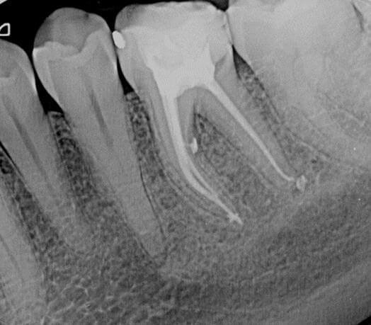 El sistema de radiovisiografía (radiografía digital) Digora nos permite obtener imágenes de alta definición con mínimas dosis de radiación El sistema de radiovisiografía (radiografía digital) Digora nos permite obtener imágenes de alta definición con mínimas dosis de radiación