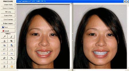 Estética dental. La simulación por ordenador de un cambio en su sonrisa permite ver cómo mejora el aspecto general de la cara Estética dental. La simulación por ordenador de un cambio en su sonrisa permite ver cómo mejora el aspecto general de la cara