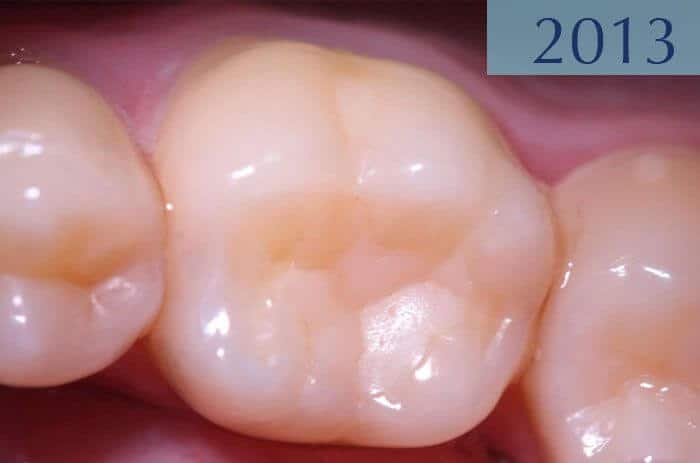 Empaste dental 16 años más tarde, realizado en el año 1997 en Clínica Dental Padrós en un tratamiento de caries dental Empaste dental 16 años más tarde, realizado en el año 1997 en Clínica Dental Padrós en un tratamiento de caries dental