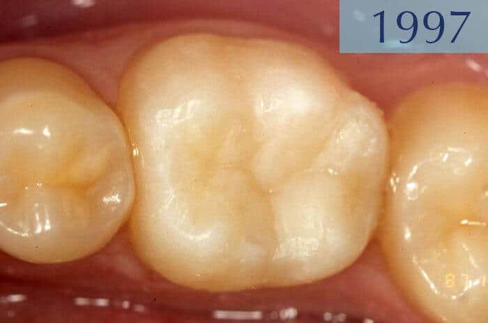 Empaste dental realizado en el año 1997 en Clínica Dental Padrós en un tratamiento de caries dental Empaste dental realizado en el año 1997 en Clínica Dental Padrós en un tratamiento de caries dental