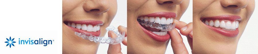 La clínica dental Padrós en Barcelona dispone del tratamiento de ortodoncia invisible invisalign, aparatos transparentes y removibles La clínica dental Padrós en Barcelona dispone del tratamiento de ortodoncia invisible invisalign, aparatos transparentes y removibles
