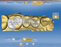 Imágenes de un caso real en clínica dental Padrós con el sistema CEREC CAD-CAM. Con el uso del software de diseño podemos mejorar el diseño y creación de restauraciones dentales, especialmente prótesis dentales incluyendo coronas, carillas, puentes, implantes y aparatos de ortodoncia Imágenes de un caso real en clínica dental Padrós con el sistema CEREC CAD-CAM. Con el uso del software de diseño podemos mejorar el diseño y creación de restauraciones dentales, especialmente prótesis dentales incluyendo coronas, carillas, puentes, implantes y aparatos de ortodoncia
