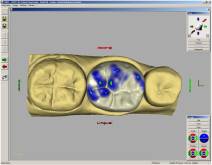 Imágenes de un caso real en clínica dental Padrós con el sistema CEREC CAD-CAM. Con el uso del software de diseño podemos mejorar el diseño y creación de restauraciones dentales, especialmente prótesis dentales incluyendo coronas, carillas, puentes, implantes y aparatos de ortodoncia Imágenes de un caso real en clínica dental Padrós con el sistema CEREC CAD-CAM. Con el uso del software de diseño podemos mejorar el diseño y creación de restauraciones dentales, especialmente prótesis dentales incluyendo coronas, carillas, puentes, implantes y aparatos de ortodoncia