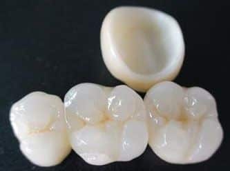 Con el uso del software de diseño CAD-CAM podemos mejorar el diseño y creación de restauraciones dentales, especialmente prótesis dentales incluyendo coronas, carillas, puentes, implantes y aparatos de ortodoncia Con el uso del software de diseño CAD-CAM podemos mejorar el diseño y creación de restauraciones dentales, especialmente prótesis dentales incluyendo coronas, carillas, puentes, implantes y aparatos de ortodoncia