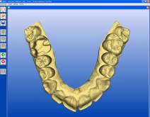 Imágenes de un caso real en clínica dental Padrós con el sistema CEREC CAD-CAM. Con el uso del software de diseño podemos mejorar el diseño y creación de restauraciones dentales, especialmente prótesis dentales incluyendo coronas, carillas, puentes, implantes y aparatos de ortodoncia Imágenes de un caso real en clínica dental Padrós con el sistema CEREC CAD-CAM. Con el uso del software de diseño podemos mejorar el diseño y creación de restauraciones dentales, especialmente prótesis dentales incluyendo coronas, carillas, puentes, implantes y aparatos de ortodoncia