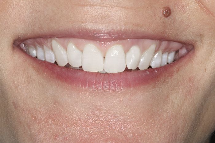 Después del tratamiento de blanqueamiento dental Después del tratamiento de blanqueamiento dental