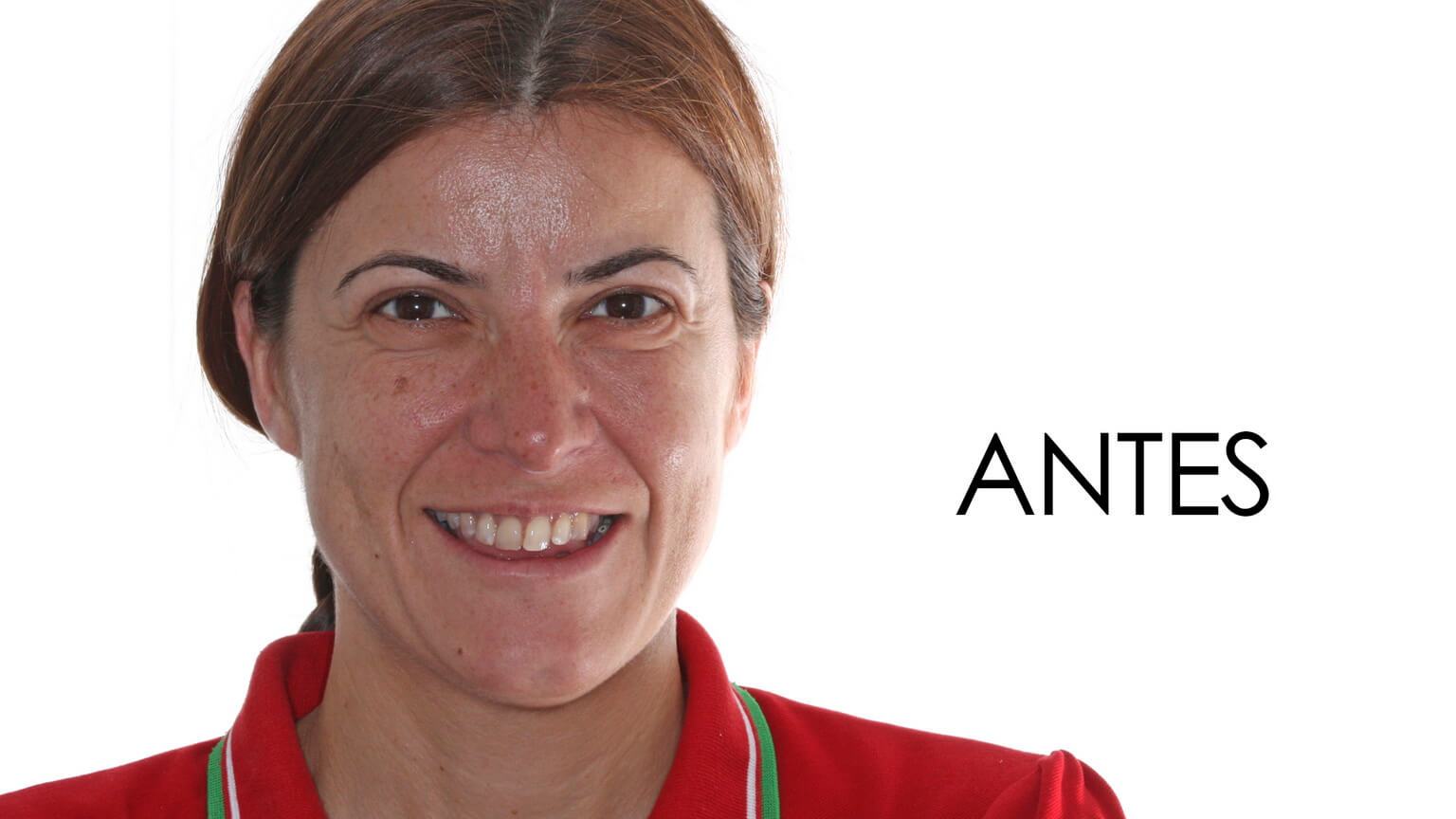 Antes del estudio de estética dental y el tratamiento de ortodoncia Antes del estudio de estética dental y el tratamiento de ortodoncia