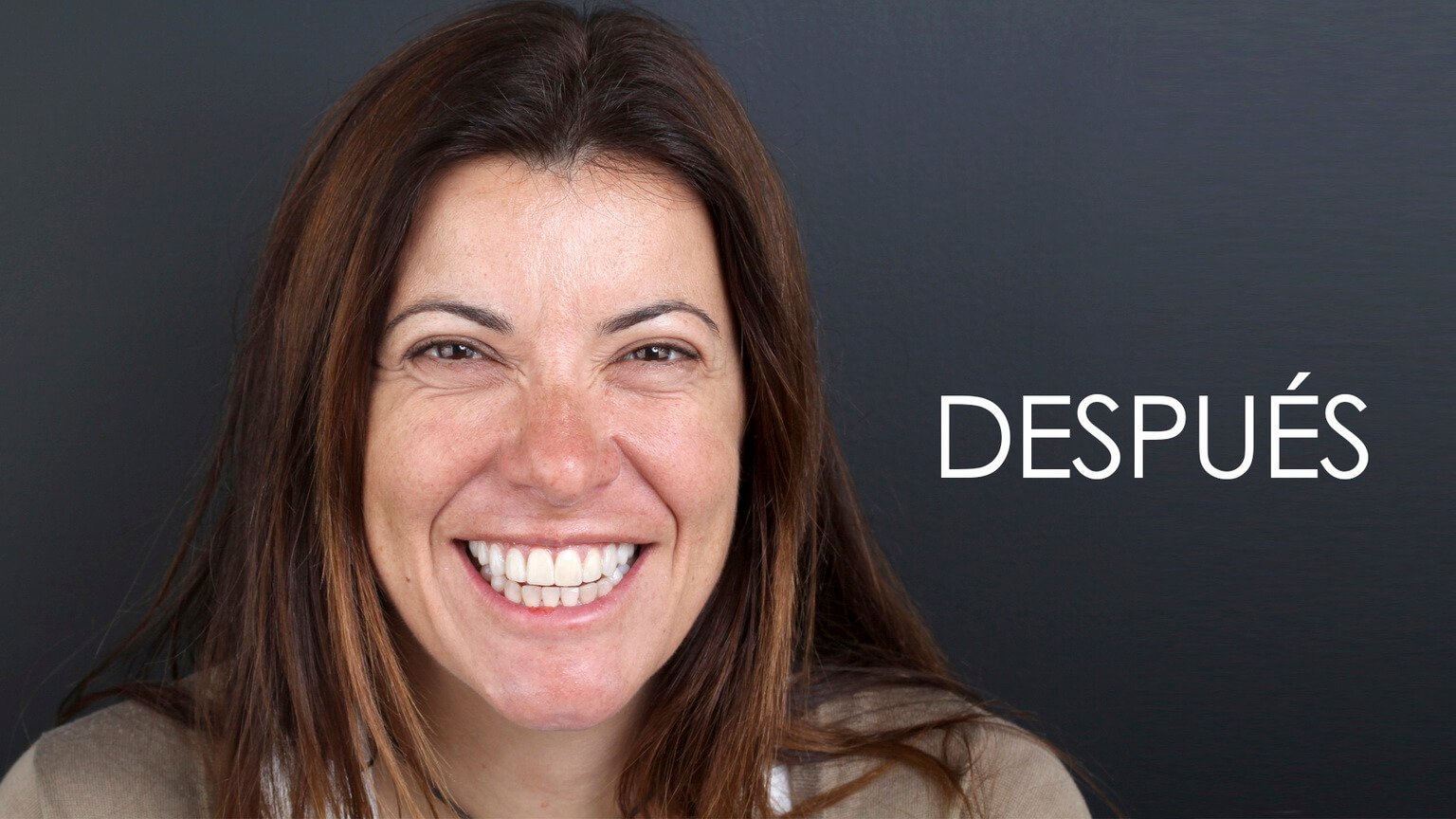 Después del estudio de estética dental y el tratamiento de ortodoncia Después del estudio de estética dental y el tratamiento de ortodoncia