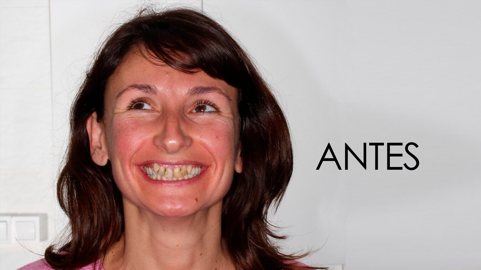 Antes del estudio de estética dental y el tratamiento de ortodoncia Antes del estudio de estética dental y el tratamiento de ortodoncia