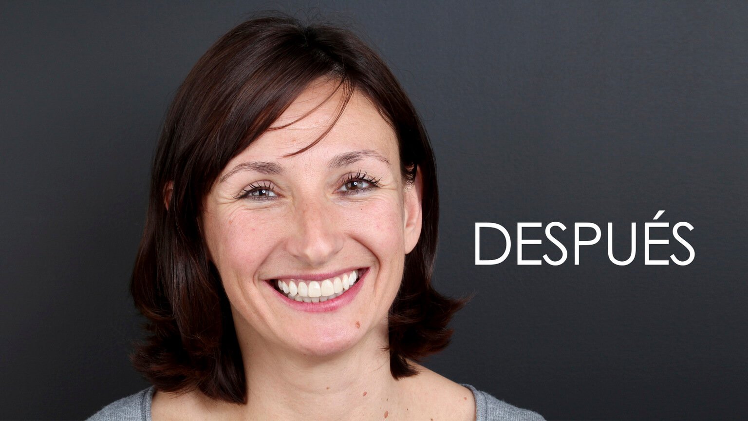 Después del estudio de estética dental y el tratamiento de ortodoncia Después del estudio de estética dental y el tratamiento de ortodoncia