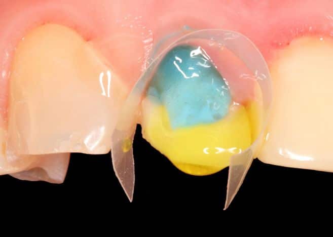 Curso de Adhesión Dental Práctica Curso de Adhesión Dental Práctica