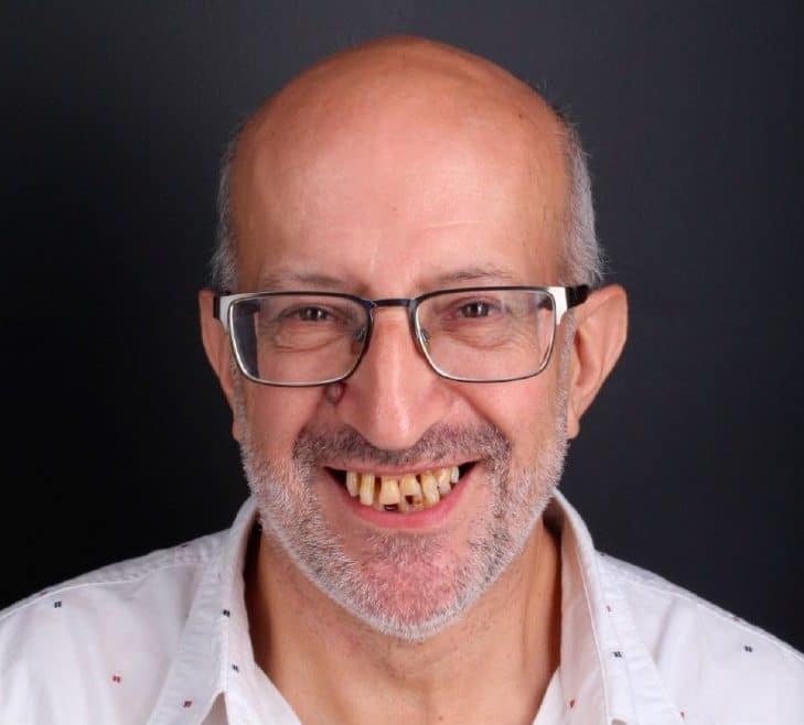 Antes del tratamiento de implantes dentales inmediatos Antes del tratamiento de implantes dentales inmediatos