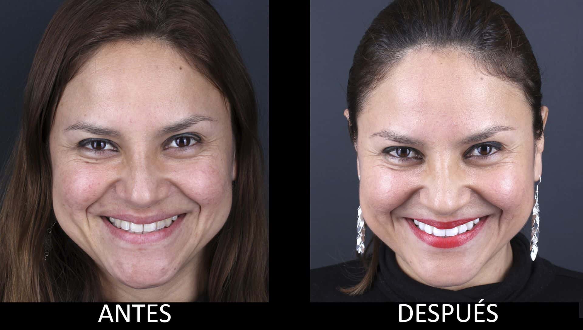 Antes y después del tratamiento de blanqueamiento dental Antes y después del tratamiento de blanqueamiento dental