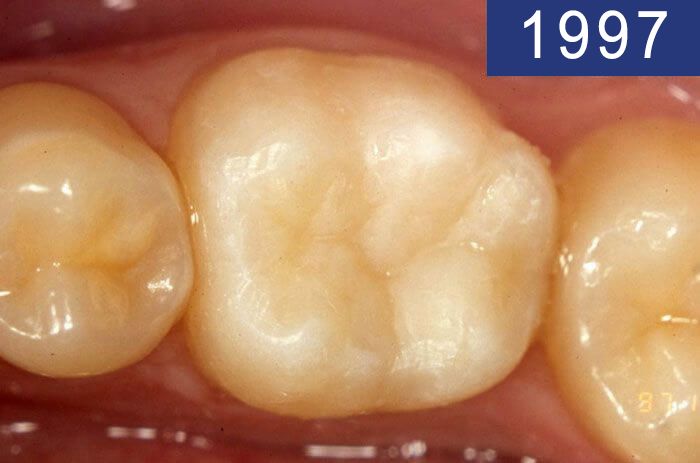 Empaste dental realizado en el año 1997 en Clínica Dental Padrós en un tratamiento de caries dental Empaste dental realizado en el año 1997 en Clínica Dental Padrós en un tratamiento de caries dental