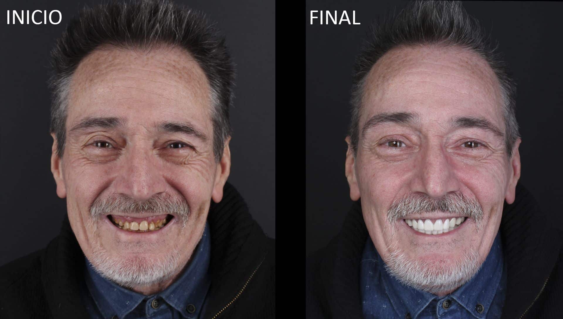 Joaquín antes y después del tratamiento de estética dental Joaquín antes y después del tratamiento de estética dental