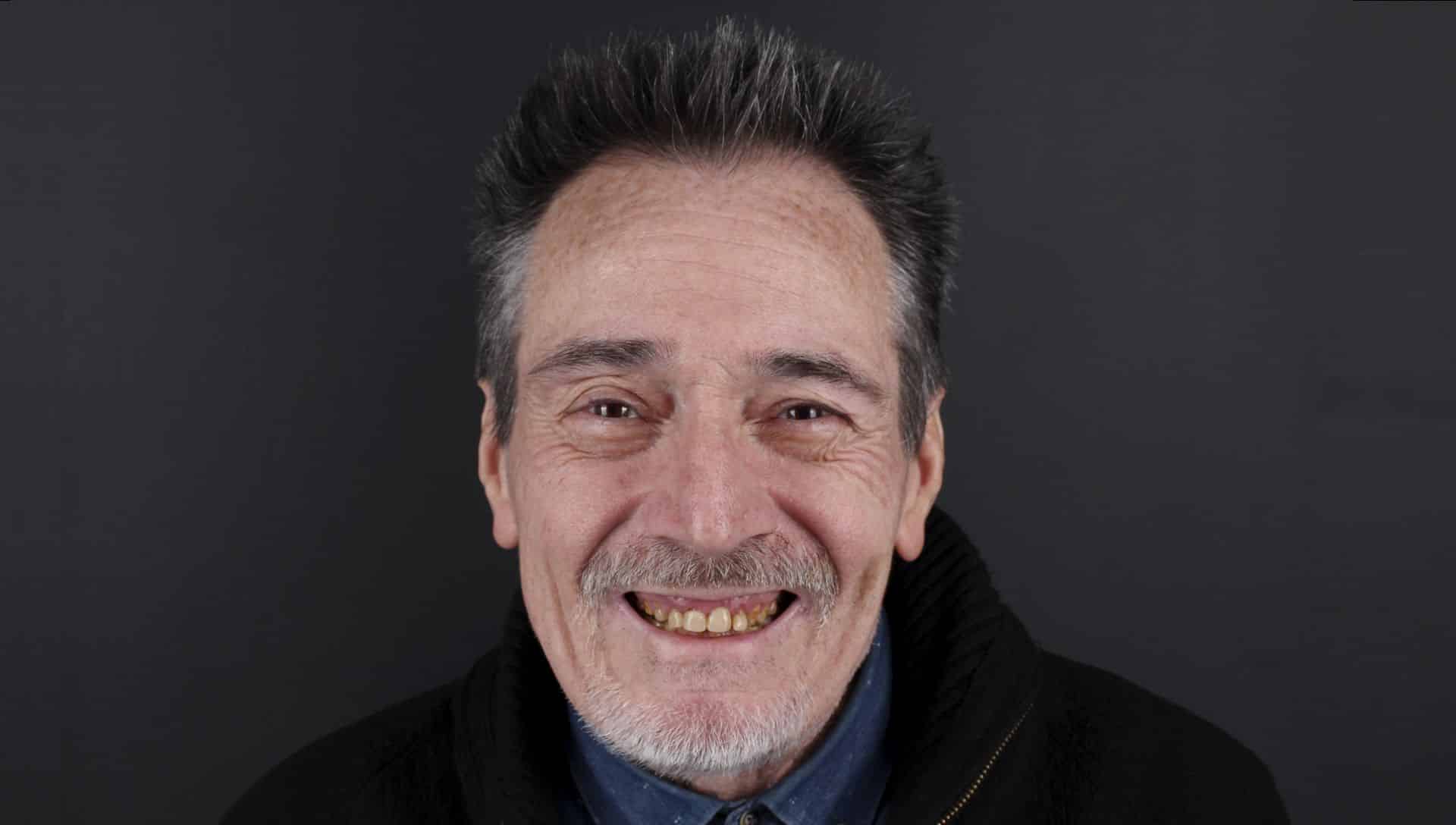 Joaquín antes del tratamiento de estética dental Joaquín antes del tratamiento de estética dental
