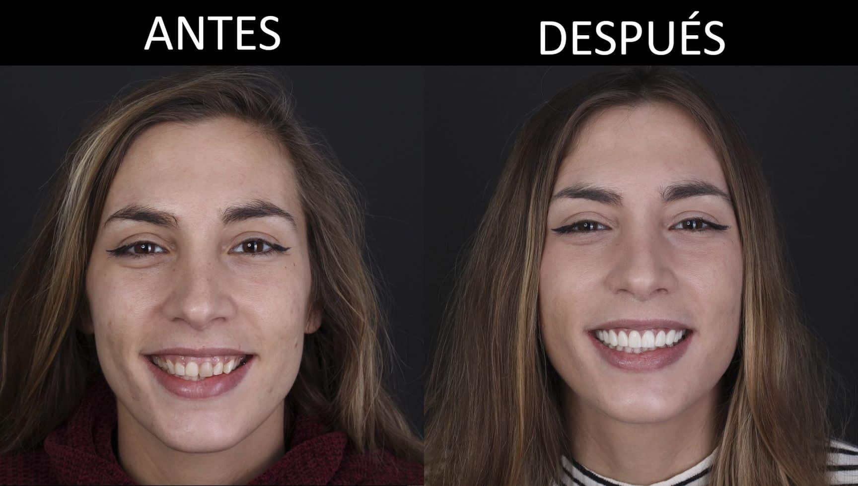 Antes y después del tratamiento de estética dental Antes y después del tratamiento de estética dental