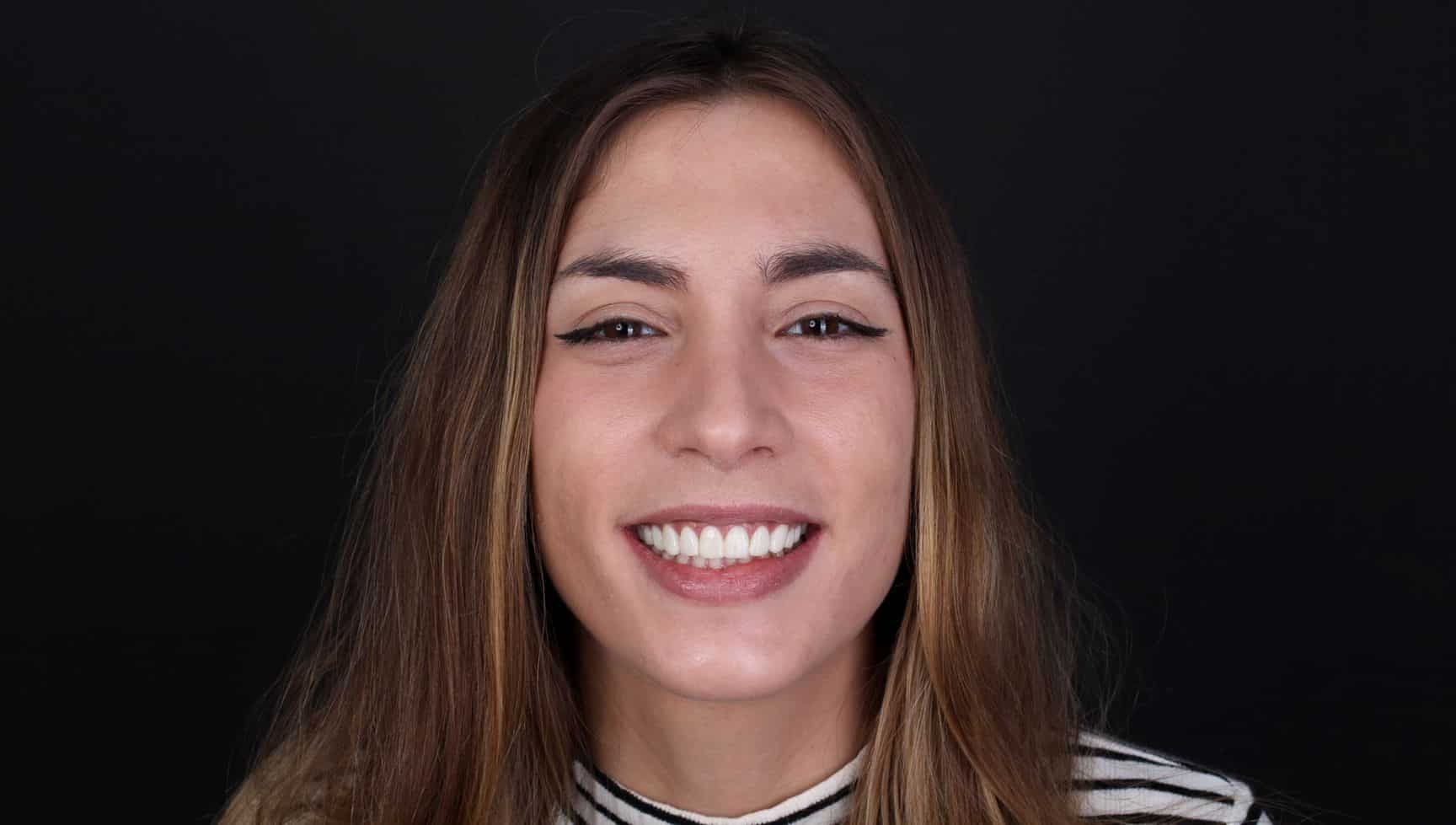 Después del tratamiento de estética dental Después del tratamiento de estética dental