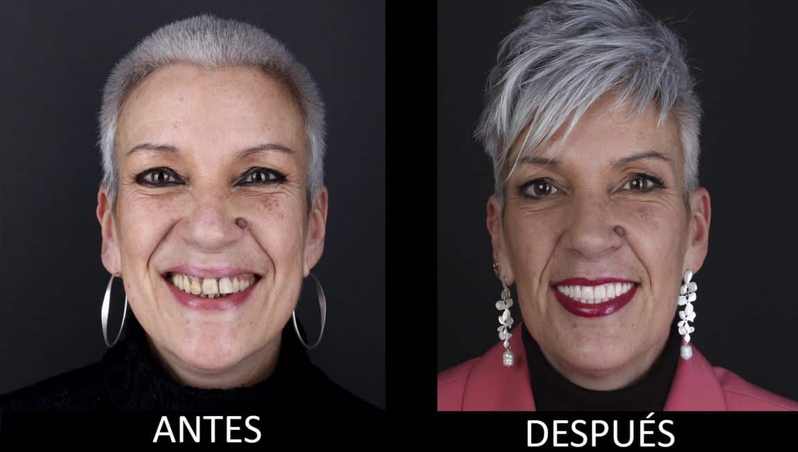 Antes y después del tratamiento de implantes dentales Antes y después del tratamiento de implantes dentales