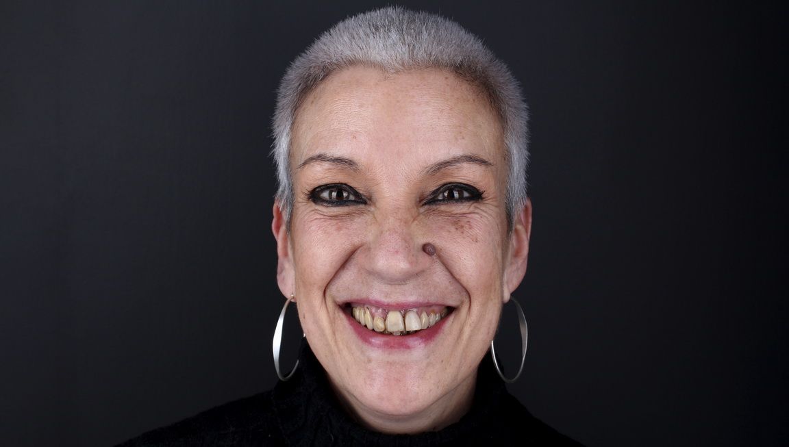 Antes del tratamiento de implantes dentales Antes del tratamiento de implantes dentales
