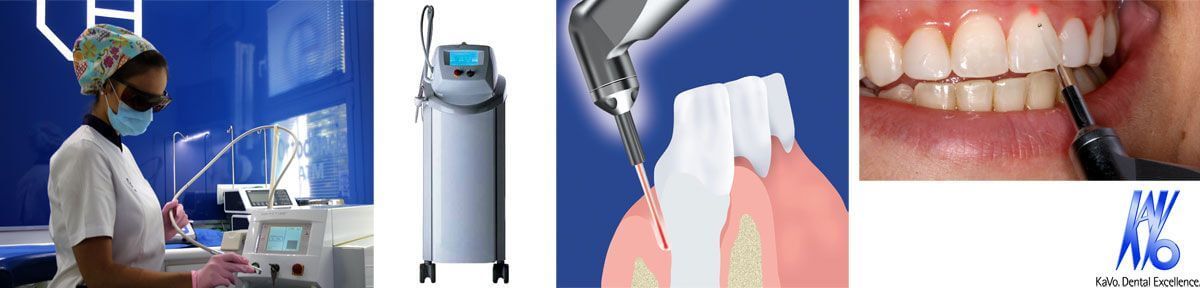 El láser dental Kavo está diseñado para tratar tejidos blandos y duros. Tiene muchas aplicaciones en odontología