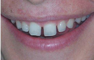 Snap on smile es un tratamiento inocuo, no invasivo de estética dental. Consiste en unas férulas estéticas de quita y pon
