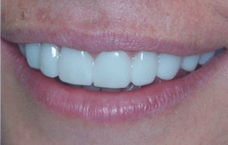 Snap on smile es un tratamiento inocuo, no invasivo de estética dental. Consiste en unas férulas estéticas de quita y pon