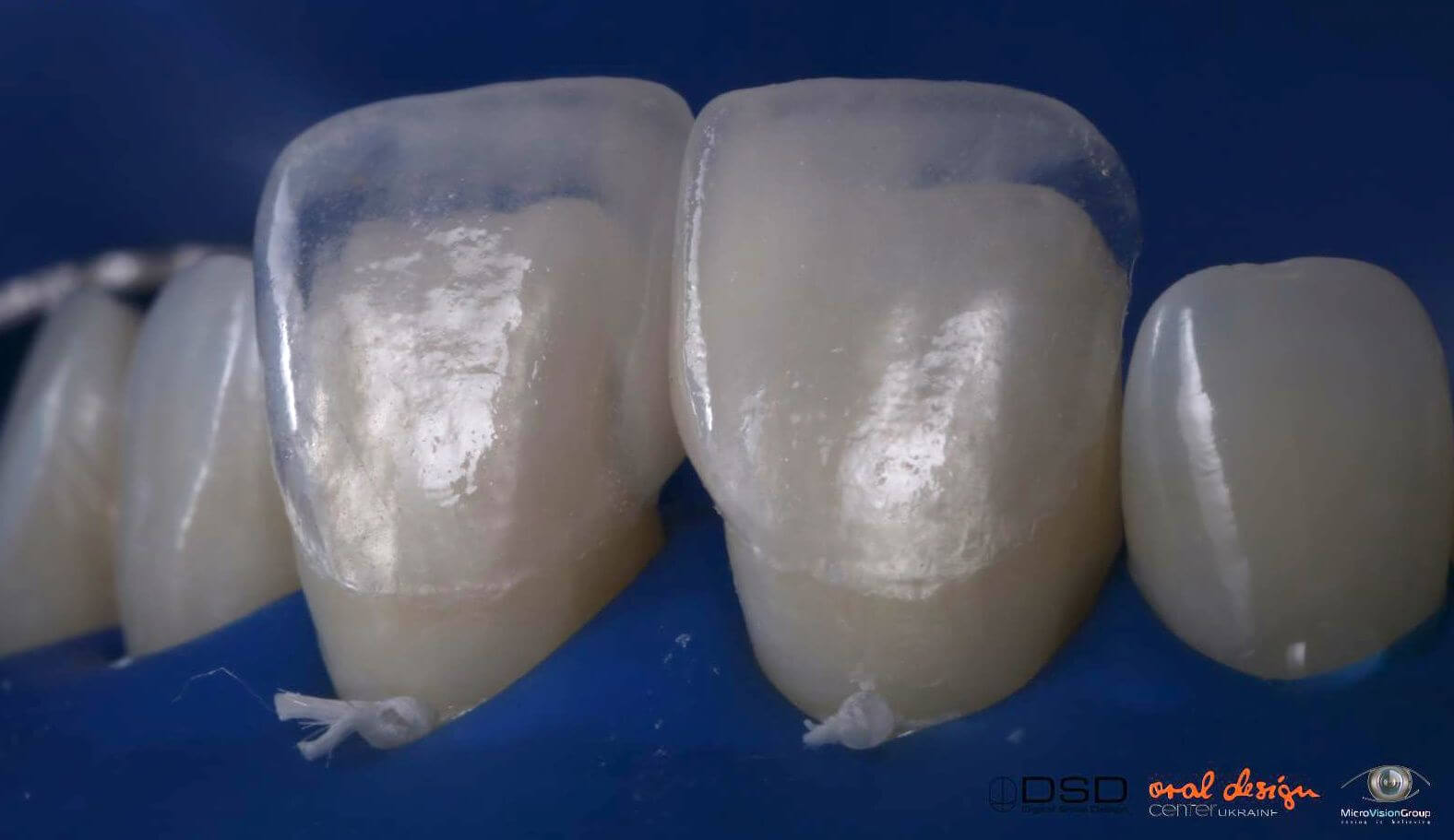 Una de las ventajas de dominar las técnicas de este tratamiento estetico microinvasivo es la posibilidad de elaborar micro-carillas de cerámica extraordinariamente estéticas y naturales pero sin desgastar los dientes.