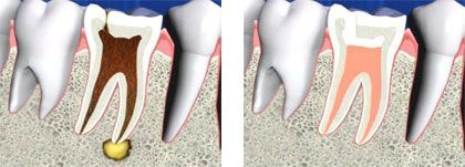 Vista interna de los dientes antes y después del tratamiento de endodoncia Vista interna de los dientes antes y después del tratamiento de endodoncia