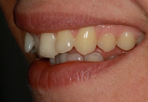 Analizando muestras de casos prácticos del tratamiento de ortodoncia rápida en Barcelona Inman Aligner. En la imagen se observa la posición de los dientes en uno de los pacientes tratados en nuestra clínica dental antes de haberse sometido al tratamiento.