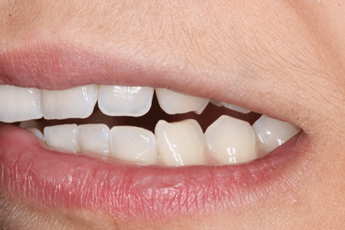 El bruxismo es el tercer trastorno del sueño más común. Uno de cada cuatro personas lo padecen. El rechinamiento o apretamiento de los dientes provoca dolor mandibular, dolor de cabeza, etc. El bruxismo es el tercer trastorno del sueño más común. Uno de cada cuatro personas lo padecen. El rechinamiento o apretamiento de los dientes provoca dolor mandibular, dolor de cabeza, etc.