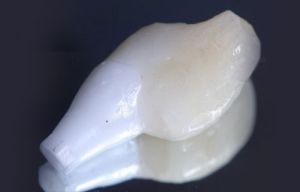 Ejemplo de un caso real tratado en la Clínica Dental Padrós de tratamiento de implantes dentales. En la imagen podemos observar el implante dental utilizado antes de la colocación en la boca del paciente.