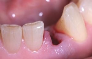 Ejemplo de un caso real tratado en la Clínica Dental Padrós antes de proceder al tratamiento de implantes dentales