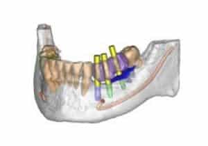 Nuestro sistema de radiología 3D Simplant nos permite programar los casos de tratamientos de implantes dentales con gran precisión. Podemos realizar cirugías virtuales, preparar plantillas, conocer la densidad del hueso en cada punto, etc. Nuestro sistema de radiología 3D Simplant nos permite programar los casos de tratamientos de implantes dentales con gran precisión. Podemos realizar cirugías virtuales, preparar plantillas, conocer la densidad del hueso en cada punto, etc.