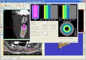 Nuestro sistema de radiología 3D Simplant nos permite programar los casos de tratamientos de implantes dentales con gran precisión. Podemos realizar cirugías virtuales, preparar plantillas, conocer la densidad del hueso en cada punto, etc. Nuestro sistema de radiología 3D Simplant nos permite programar los casos de tratamientos de implantes dentales con gran precisión. Podemos realizar cirugías virtuales, preparar plantillas, conocer la densidad del hueso en cada punto, etc.