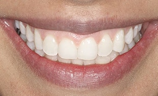Blanqueamiento dental