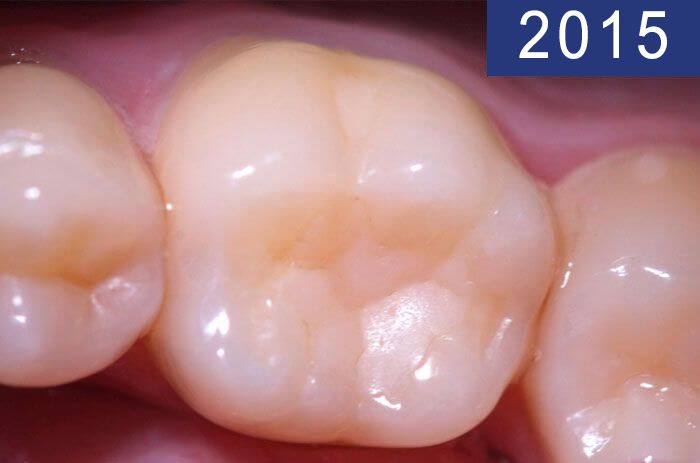 Empaste dental 18 años más tarde, realizado en el año 1997 en Clínica Dental Padrós en un tratamiento de caries dental