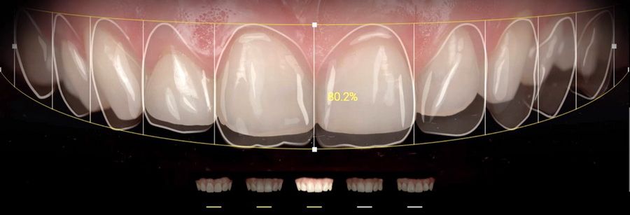Aplicaciones como Smile Cloud, Ivosmile, DSDapp o Snap Dental nos ayudan en el cálculo de proporciones, elección de la forma, color y posición de los dientes en su nueva sonrisa y nos permiten llevar a cabo simulaciones digitales para ayudarnos a escoger tu nueva sonrisa.