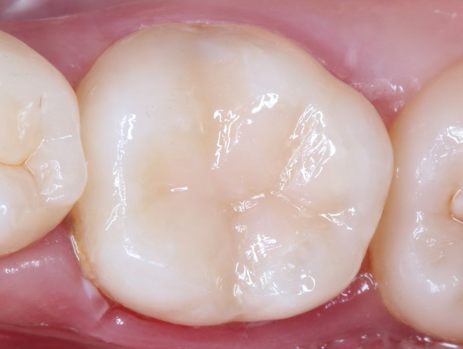El Carisolv permite disolver de forma muy controlada y conservadora el tejido dental con caries, respetando los tejidos dentales sanos