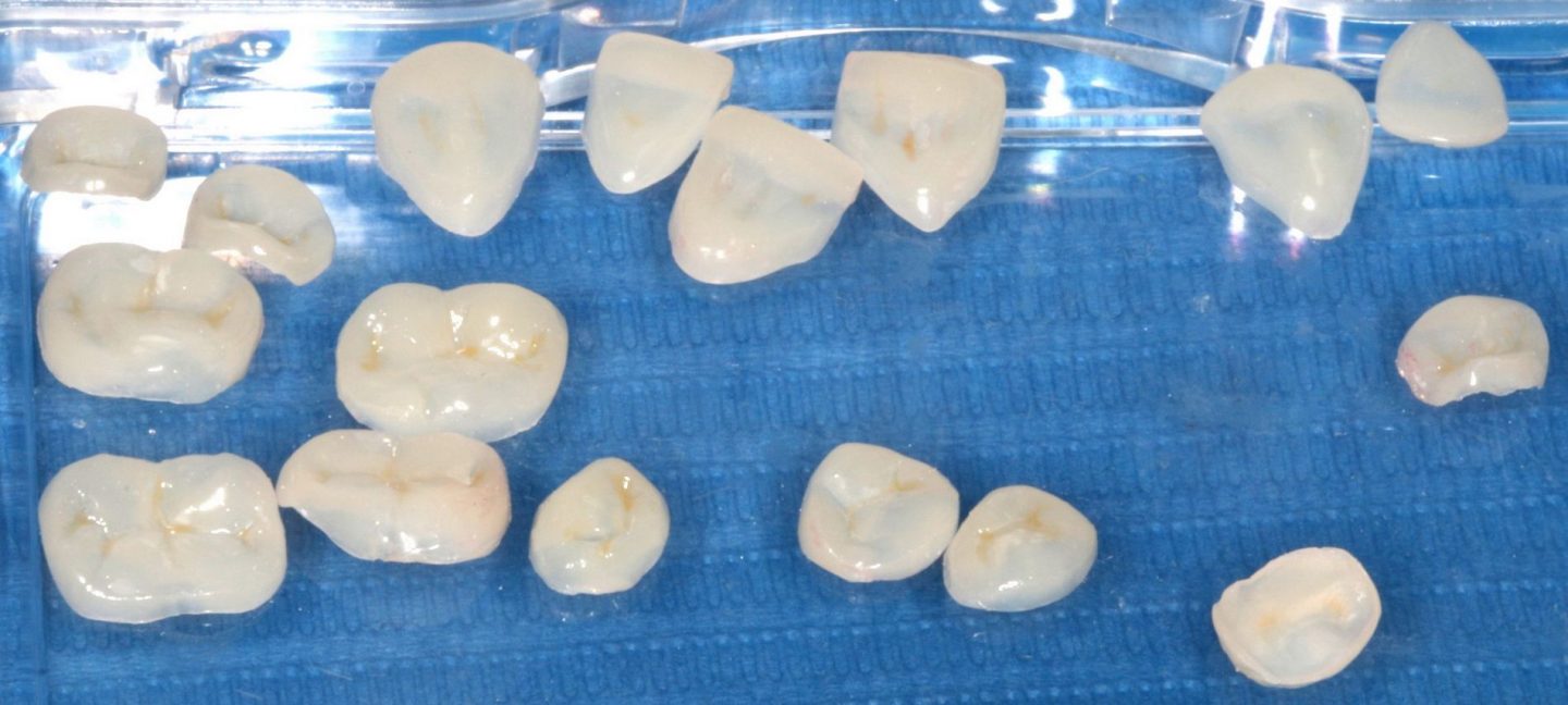 Caso de desgaste dental tratado en nuestra clínica dental en Barcelona