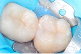 Tratamiento de eliminación de amalgamas, antiguos empastes metálicos en clínica dental Padrós. Tu dentista en Barcelona