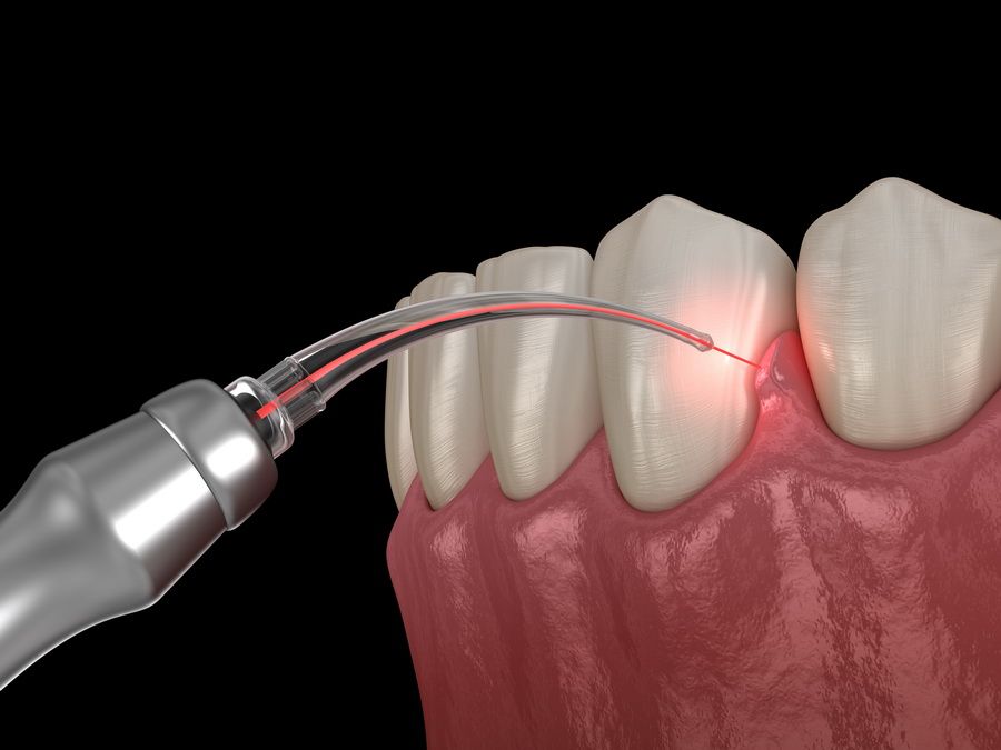 Tratamiento periodontal de las encías para enfermedades como la gingivitis y la periodontitis en la clínica dental Padrós en Barcelona