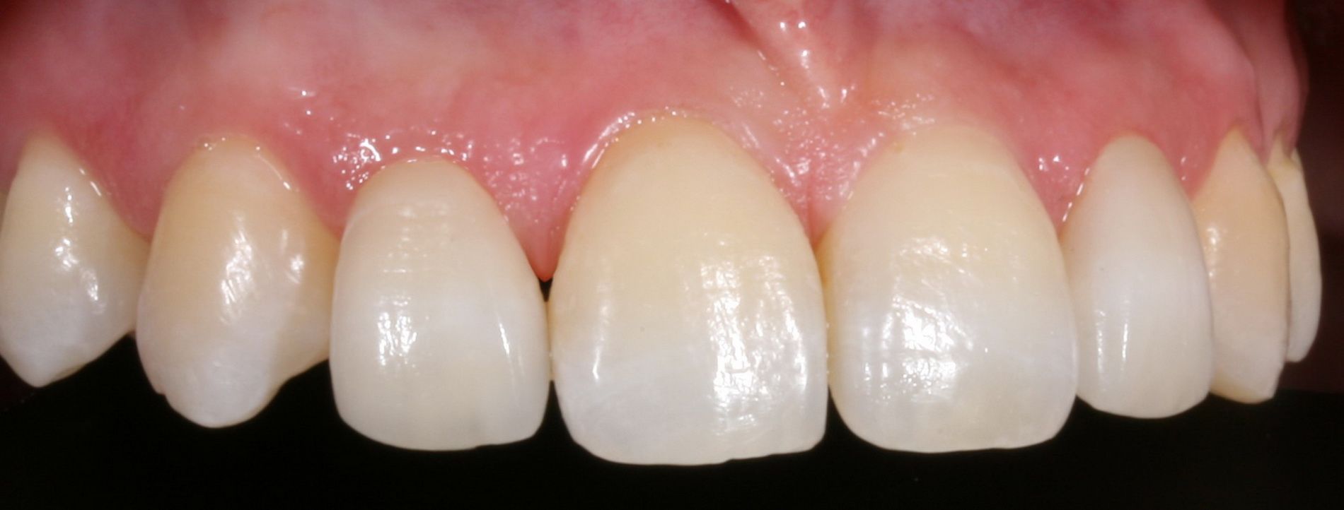 El sistema Cerec 3D de CAD-CAM dental permite confeccionar restauraciones dentales con una precisión de ajuste de 30 micras.