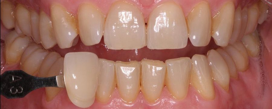 Tratamiento de estética blanqueamiento dental. Clínica dental Padrós, dentista en Barcelona