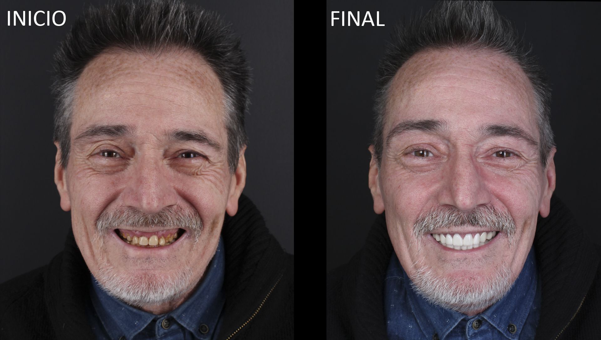 Antes y después del tratamiento de prótesis dentales