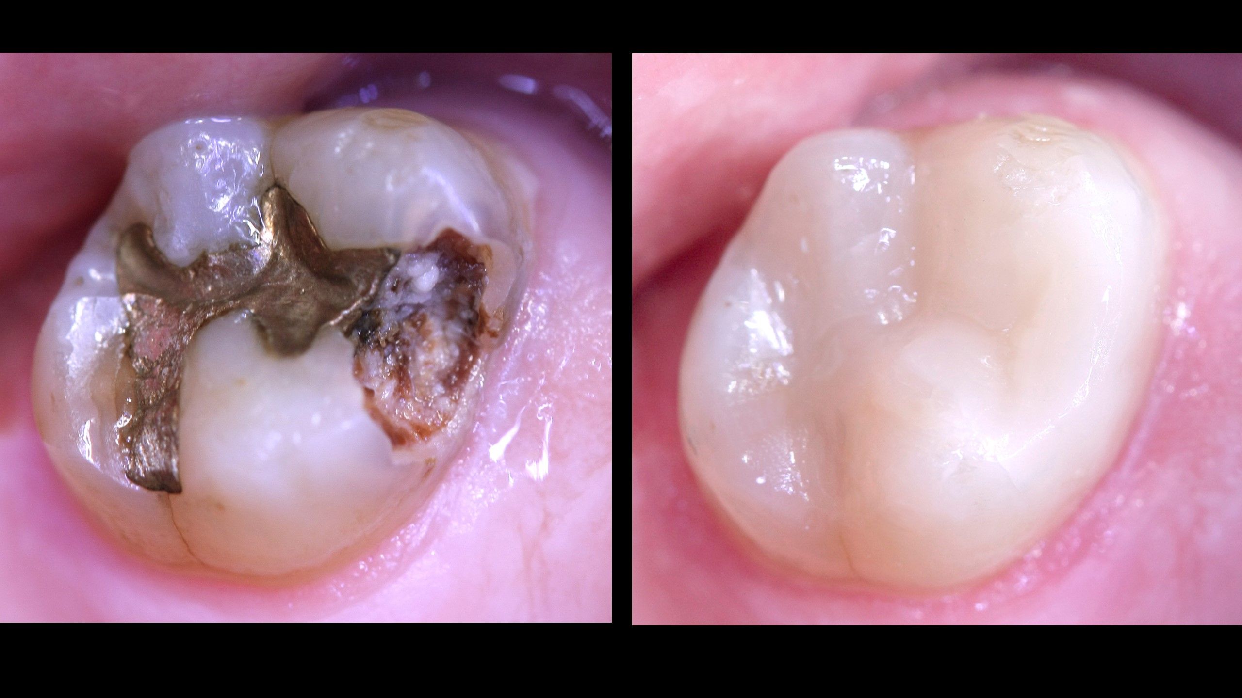 Tratamiento de eliminación de amalgamas, antiguos empastes metálicos en clínica dental Padrós. Tu dentista en Barcelona