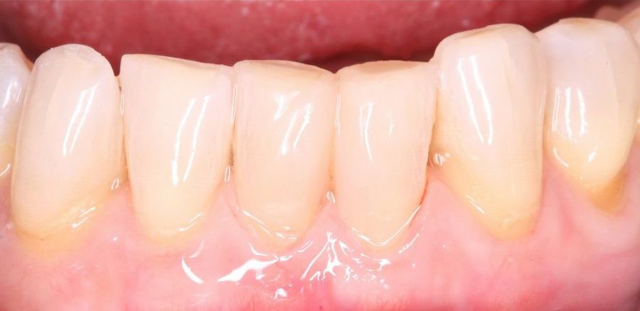 Tratamiento de los triángulos negros entre los dientes