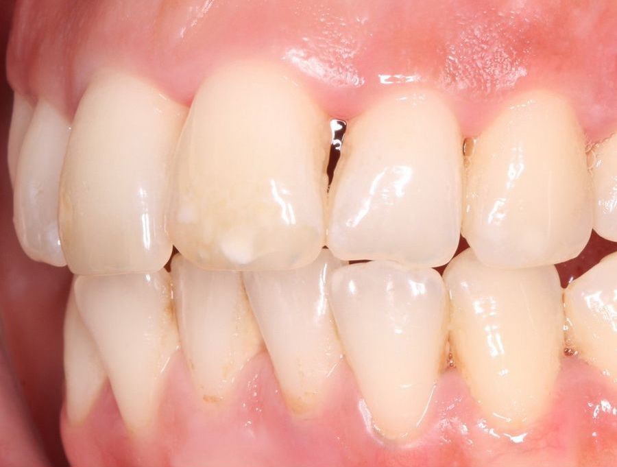 Tratamiento de estética de las encías retraidas. Clínica dental Padrós, dentista en Barcelona