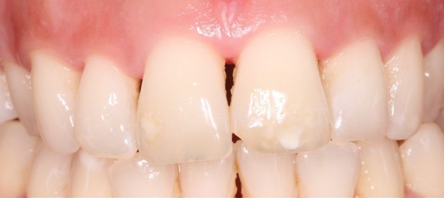 Tratamiento de estética de las encías retraidas. Clínica dental Padrós, dentista en Barcelona