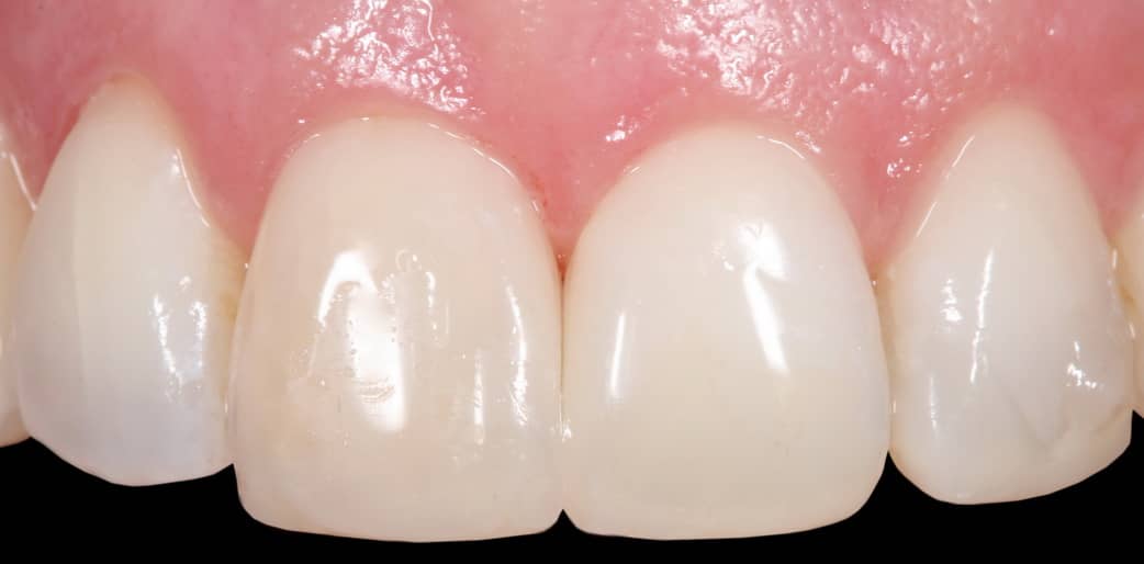Tratamiento de los triángulos negros entre los dientes